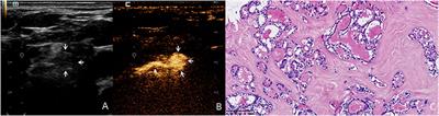 Microbubble contrast agent SonoVue: An efficient medium for the preoperative lymphatic mapping of thyroid carcinoma